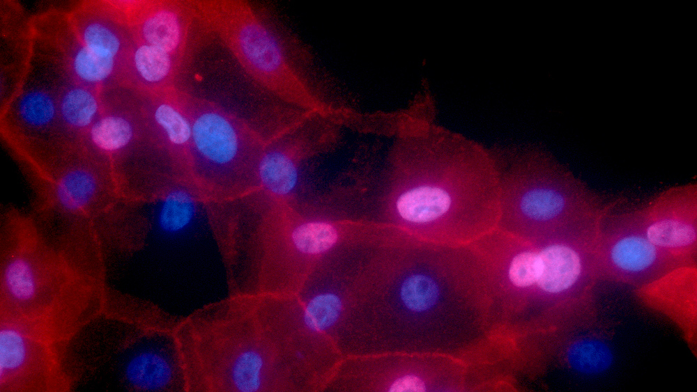 human breast cancer cells